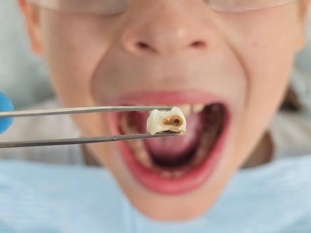 Best Emergency Treatment for Oral Infections in Fourche Crossing, LA